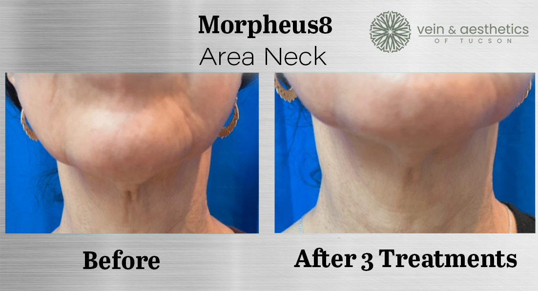 chin area